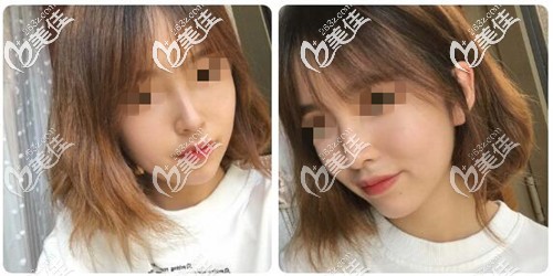 自体肋软骨隆鼻3个月恢复效果 自体肋软骨隆鼻3个月恢复效果