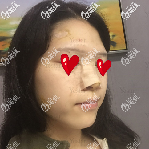 济南艺星面部脂肪填充后