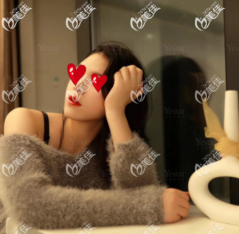 济南艺星面部脂肪填充后20天