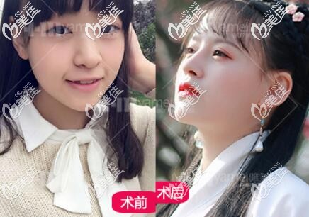 在长沙雅美做鼻综合术前术后对比照 在长沙雅美做鼻综合术前术后对比照