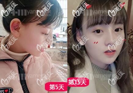 鼻综合术后5-15天的恢复效果图 鼻综合术后5-15天的恢复效果图