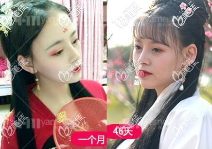 在长沙做鼻综合术后30-46天的恢复照片 在长沙做鼻综合术后30-46天的恢复照片