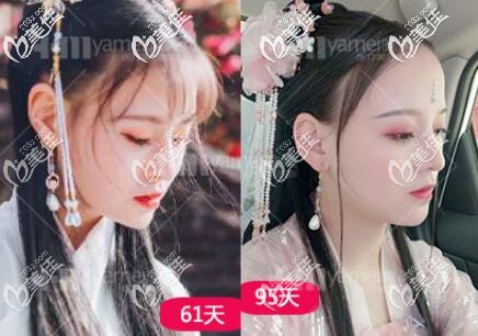 在雅美做鼻综合术后61-95天恢复效果图 在雅美做鼻综合术后61-95天恢复效果图
