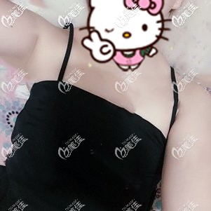 隆胸手术前自己的平胸 隆胸手术前自己的平胸