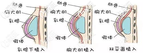 20200525_1590390195439334.jpg 假体隆胸.jpg