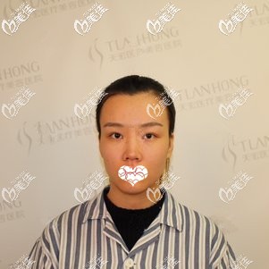 术前鼻子扁塌 术前鼻子扁塌