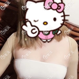 复合式隆胸术后即刻胸部变大 复合式隆胸术后即刻胸部变大