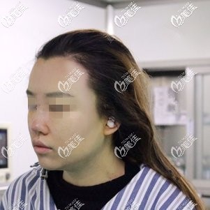 术后鼻子肿胀感较强烈 术后鼻子肿胀感较强烈