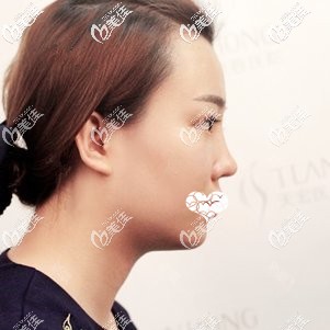 鼻综合术后一周鼻子消肿 鼻综合术后一周鼻子消肿