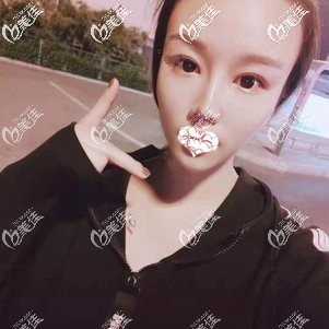 隆鼻术后1个月鼻子完全消肿 隆鼻术后1个月鼻子完全消肿