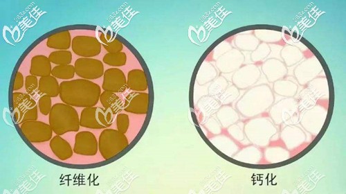 脂肪出现纤维化和钙化的情况 脂肪出现纤维化和钙化的情况