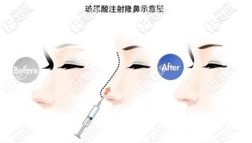 赵霞院长玻尿酸隆鼻特点图解