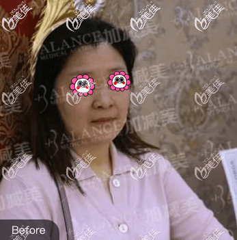 做V美减龄面部提升术前旧照 做V美减龄面部提升术前旧照