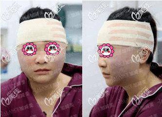 做V美减龄术后头一日 做V美减龄术后头一日