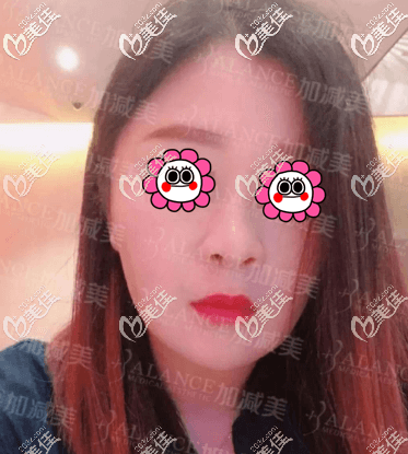 了解了V美减龄怎么做和保持时间我就做了手术 了解了V美减龄怎么做和保持时间我就做了手术