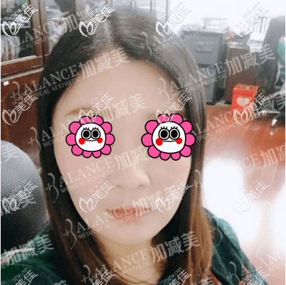 我的V美减龄面部提升术后一个月效果图 我的V美减龄面部提升术后一个月效果图