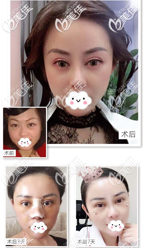 羡慕我做的埋线双眼皮自然，闺蜜也在南京容丽妍做了眼综合+鼻综合的网红套餐