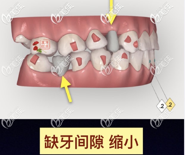牙齿缺失太久，间隙变小怎么办