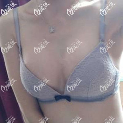 隆胸一个月摸着很不错