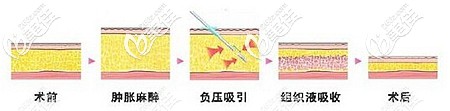 解析腰腹吸脂的原理