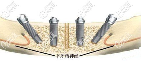 北京全口种植牙的价格 北京全口种植牙的价格