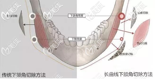 长曲线下颌角跟出啊同下颌角区别 长曲线下颌角跟出啊同下颌角区别