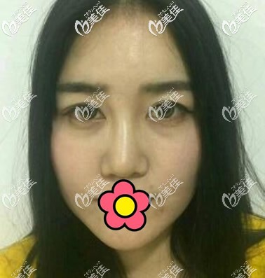 兰州仁和整形医院耳软骨隆鼻前 兰州仁和整形医院耳软骨隆鼻前