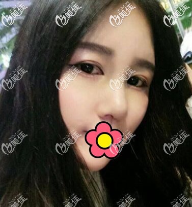 耳软骨垫鼻尖+硅胶隆鼻一个月效果图 耳软骨垫鼻尖+硅胶隆鼻一个月效果图