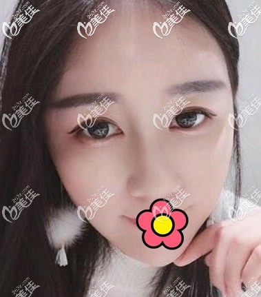 兰州仁和<!--<i data=20240703-sp></i>-->做耳软骨隆鼻半个月 兰州仁和<!--<i data=20240703-sp></i>-->做耳软骨隆鼻半个月