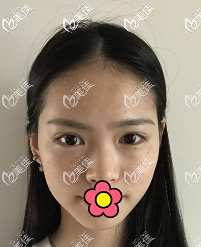 兰州仁和整形医院皮秒激光祛斑前 兰州仁和整形医院皮秒激光祛斑前