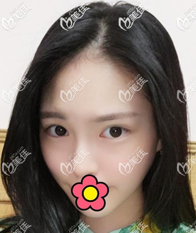 美国755蜂巢皮秒祛斑10天效果 美国755蜂巢皮秒祛斑10天效果