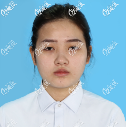 去广州广美做双眼皮隆鼻术前照片 去广州广美做双眼皮隆鼻术前照片