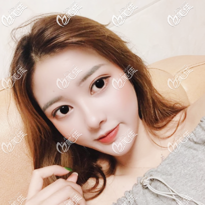 广州广美整形徐立志医生双眼皮隆鼻案例 广州广美整形徐立志医生双眼皮隆鼻案例