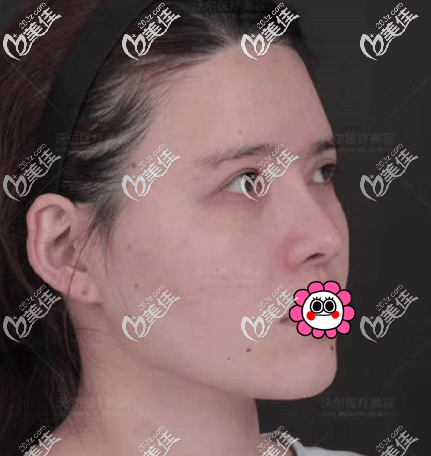 做鼻部修复前侧面照