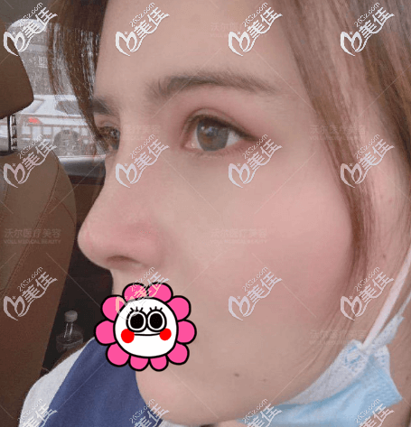 我做鼻修复后五个月<span style=