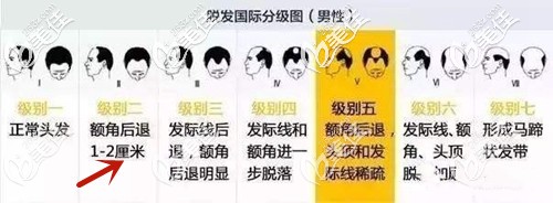 额角脱发等级分布图 额角脱发等级分布图