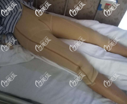 泰国塔娜做大腿吸脂手术后第二天的照片