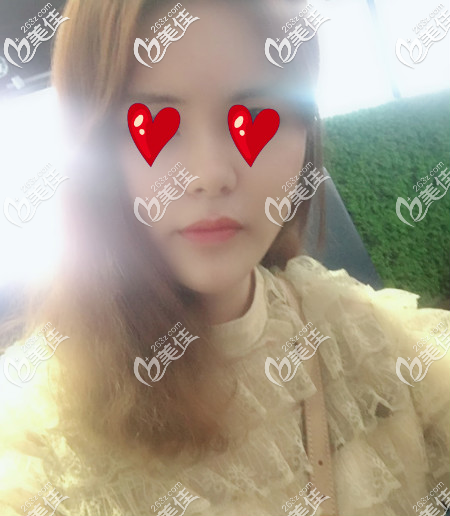 青岛华颜美做面部自体脂肪填充手术第四周的样子