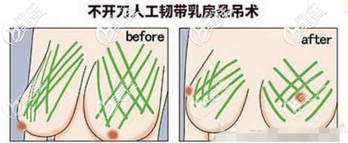 不开刀人工韧带提胸手术矫正乳房下垂不留疤