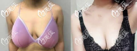 人工韧带提胸术后图片