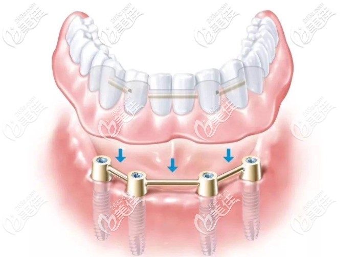 allon4种植牙图片 allon4种植牙图片