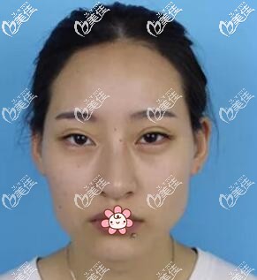 我术前的样子 我术前的样子