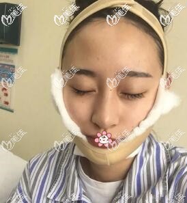 我在咖蒙医院做完磨骨一周 我在咖蒙医院做完磨骨一周