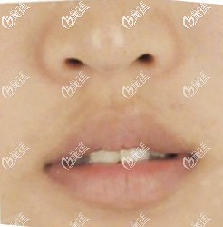 兰州韩美整形医院做厚唇变薄术前 兰州韩美整形医院做厚唇变薄术前