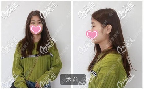 双眼皮手术前单眼皮的样子 双眼皮手术前单眼皮的样子