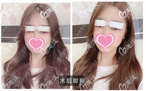 双眼皮手术后即刻效果 双眼皮手术后即刻效果