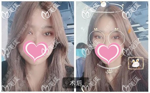 双眼皮手术恢复7天的效果图 双眼皮手术恢复7天的效果图