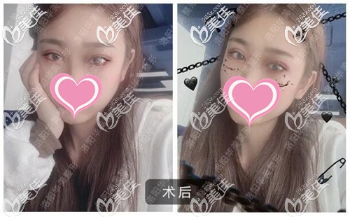 双眼皮手术恢复一个月的效果 双眼皮手术恢复一个月的效果