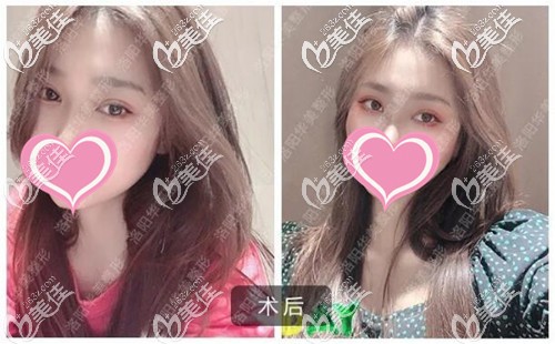 双眼皮手术恢复三个月没有疤痕增生 双眼皮手术恢复三个月没有疤痕增生