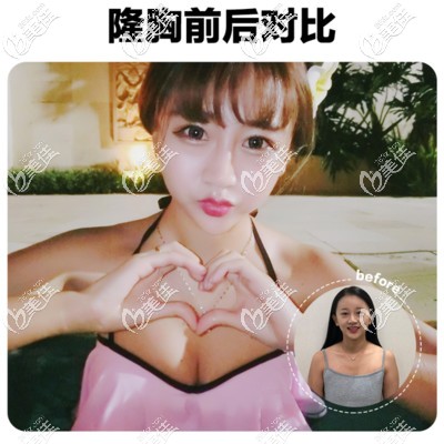 北京韩啸棉花糖丰胸案例效果图
